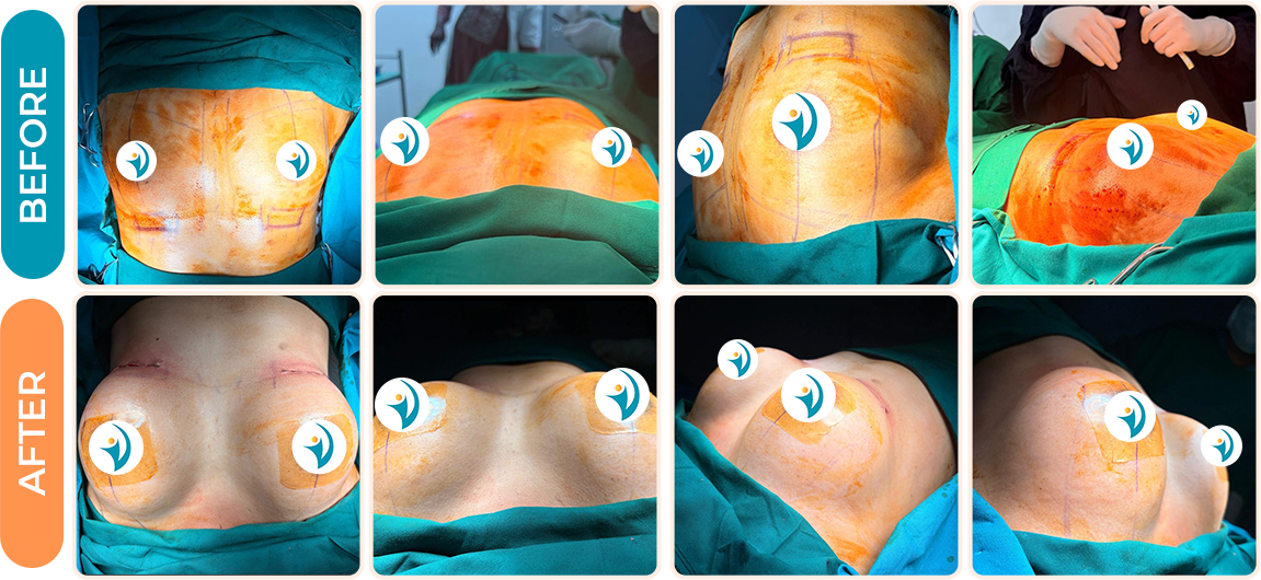Silicone Breast Implant Before and After results